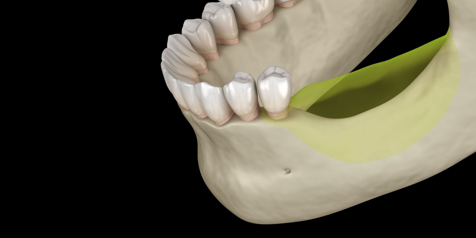 jaw bone loss