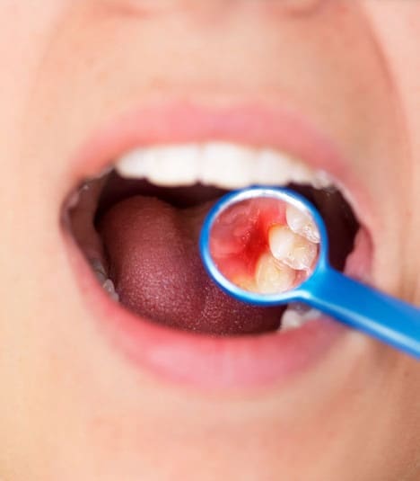 Dental Patient With A Mirror In Their Mouth Showing Their Need For Periodontal Treatment