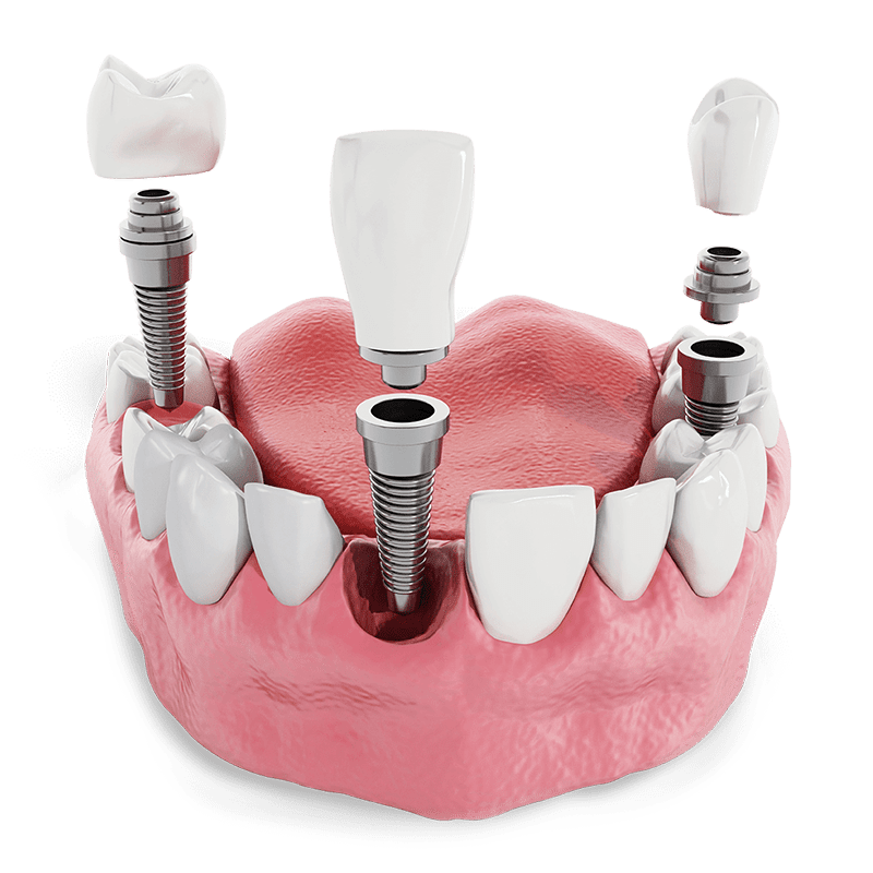 Three Dental Implants Placed Around The Front And Sides Of The Mouth, Showing Different Parts Of The Implant, Such As The Implants, The Abutments, And The Crowns