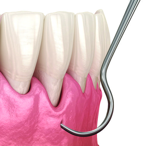 Pinhole Surgical Technique Being Utilized to Treat Gum Recession