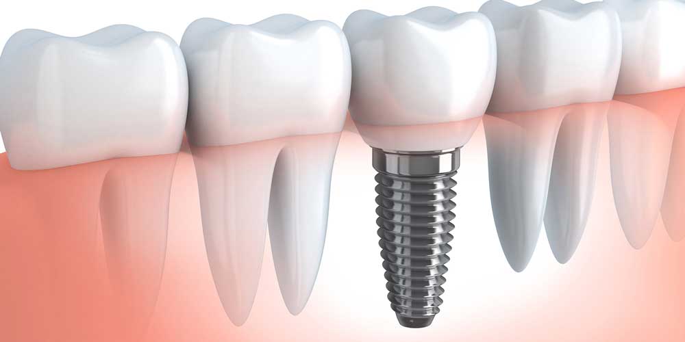 Dental Implant