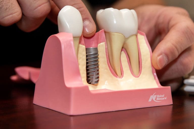 Dental Implant