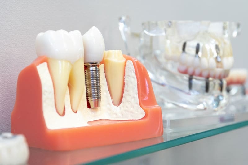 Dental Implant