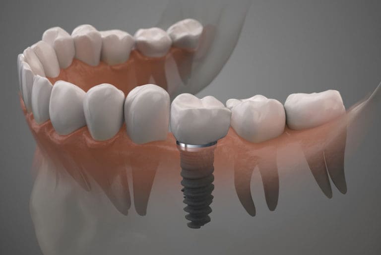 dental implants