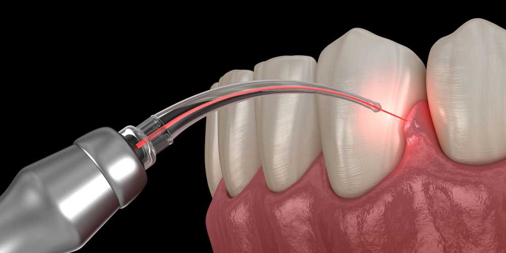 gum disease treatment laser