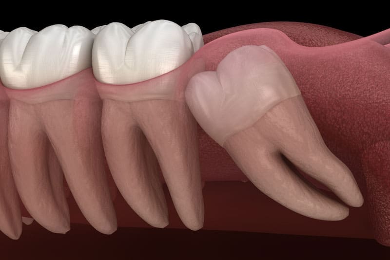 impacted wisdom tooth