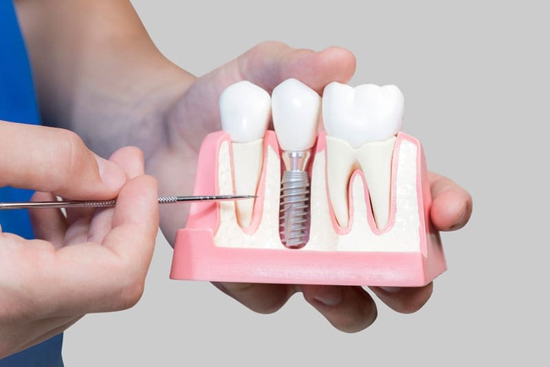 Dental Assistant Showing Off A Dental Implant In A Jawbone Cutaway Model in Harrisonburg, VA